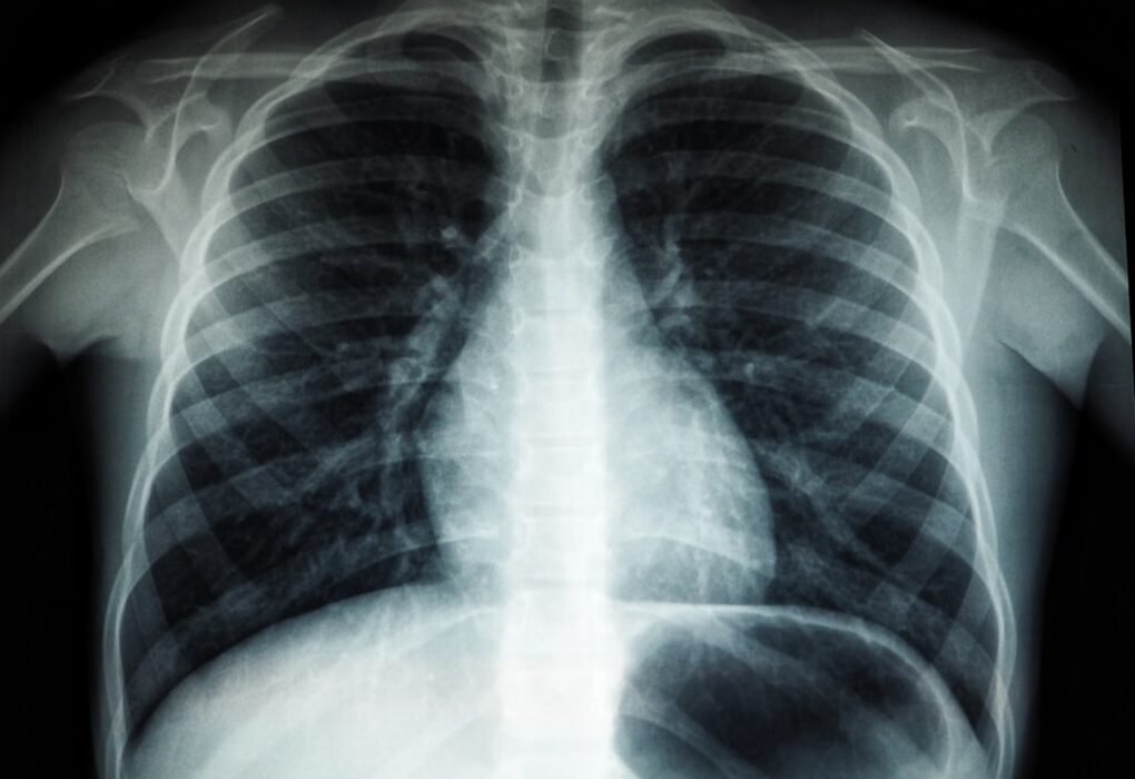 Photo Lung Function Improvement