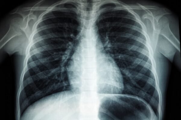 Photo Lung Function Improvement